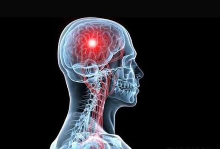 Εγκεφαλικό επεισόδιο: Οι τέσσερις κινήσεις που σώζουν ζωές